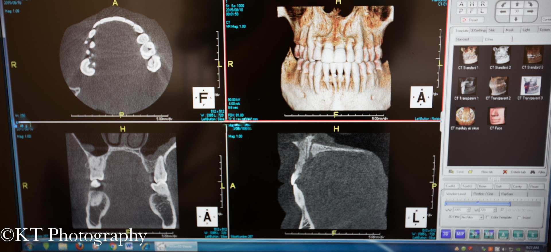 CBCT Scan Results